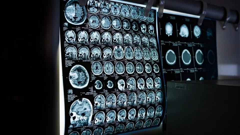 Studiu: Densitatea osoasă scăzută ar putea fi asociată cu declinul cognitiv